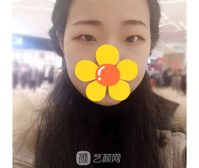 脂美人雙眼皮手術(shù)大公開！我終于整容了！