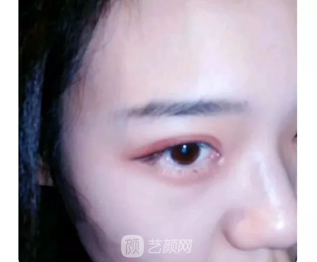 脂美人雙眼皮手術(shù)大公開！我終于整容了！