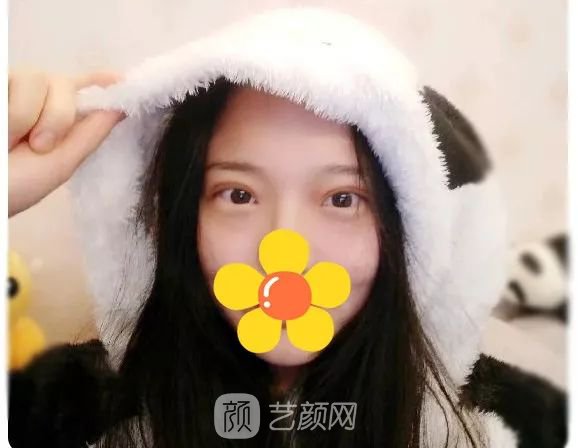 脂美人雙眼皮手術(shù)大公開！我終于整容了！