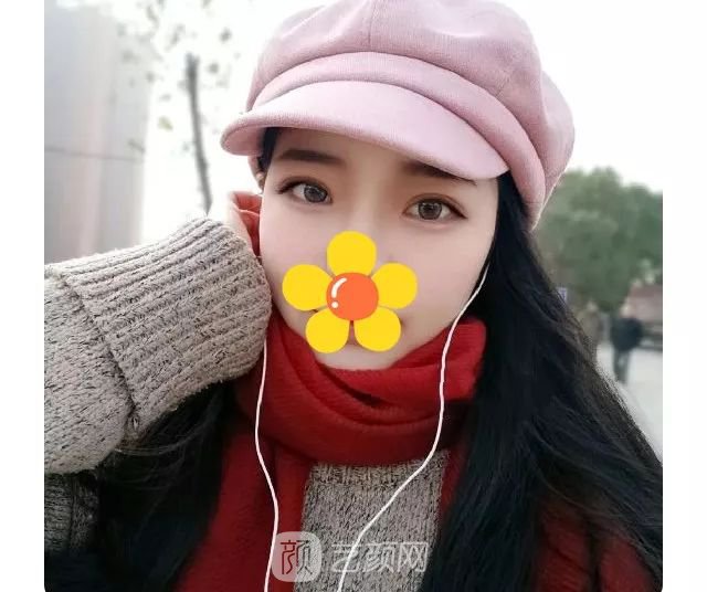 脂美人雙眼皮手術(shù)大公開！我終于整容了！