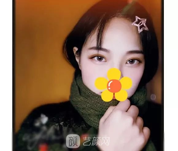 脂美人雙眼皮手術(shù)大公開！我終于整容了！