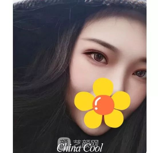 脂美人雙眼皮手術(shù)大公開！我終于整容了！