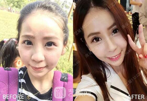 只需要5分鐘，我的鼻子變高了！——南京藝星玻尿酸隆鼻~