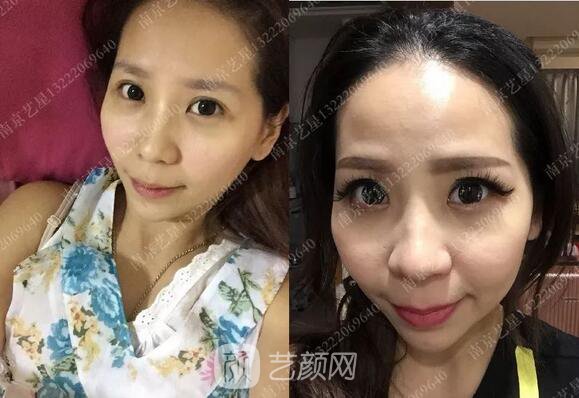 只需要5分鐘，我的鼻子變高了！——南京藝星玻尿酸隆鼻~