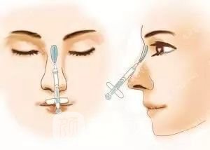 只需要5分鐘，我的鼻子變高了！——南京藝星玻尿酸隆鼻~