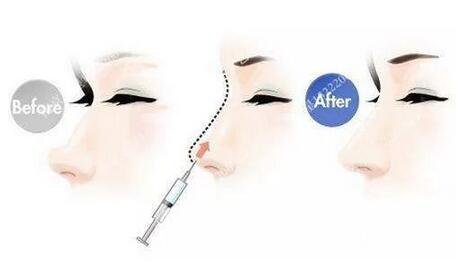 只需要5分鐘，我的鼻子變高了！——南京藝星玻尿酸隆鼻~