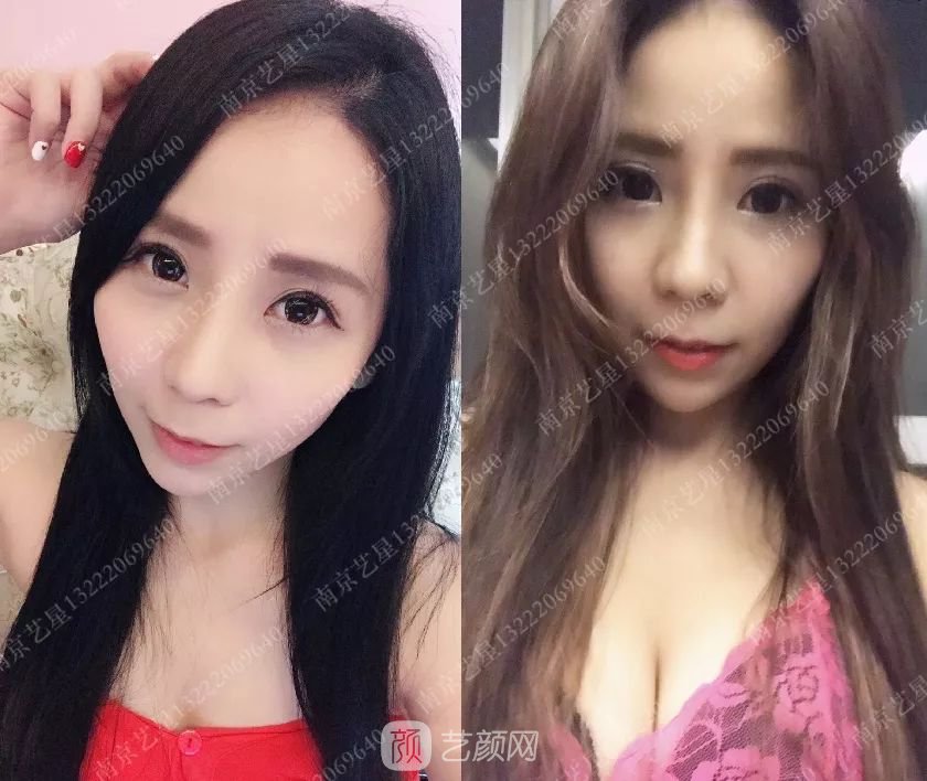 只需要5分鐘，我的鼻子變高了！——南京藝星玻尿酸隆鼻~