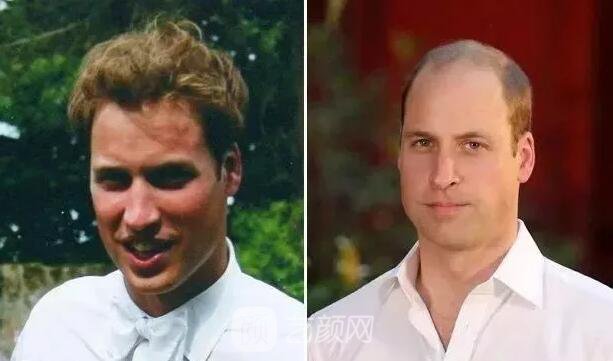 徐崢回應(yīng)脫發(fā)、英國小刺猬因壓力大脫毛！不得不說“禿”真是不分界的...