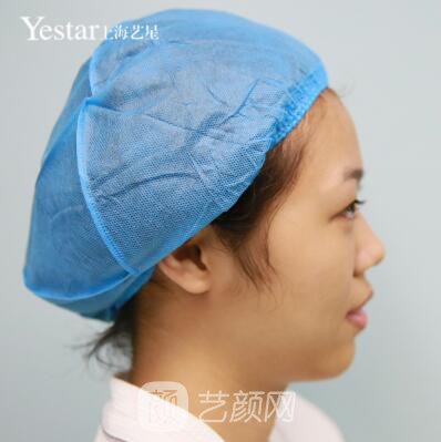 上海藝星切開雙眼皮案例，論雙眼皮的重要性