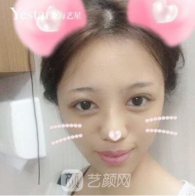 上海藝星切開雙眼皮案例，論雙眼皮的重要性