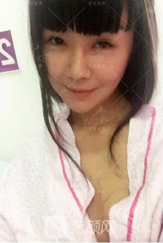 產(chǎn)后媽媽假體隆胸真實案例恢復(fù)過程