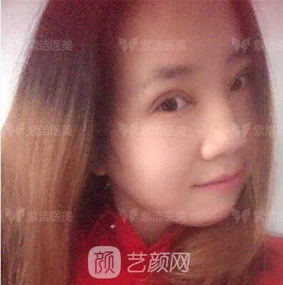 北京紫潔醫(yī)療美容全切雙眼皮案例過程恢復(fù)