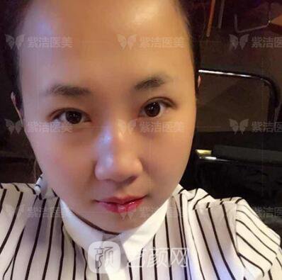 北京紫潔醫(yī)療美容全切雙眼皮案例過程恢復(fù)