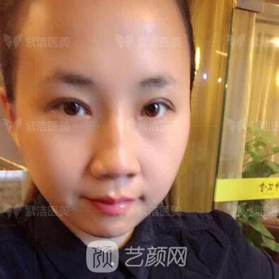 北京紫潔醫(yī)療美容全切雙眼皮案例過程恢復(fù)