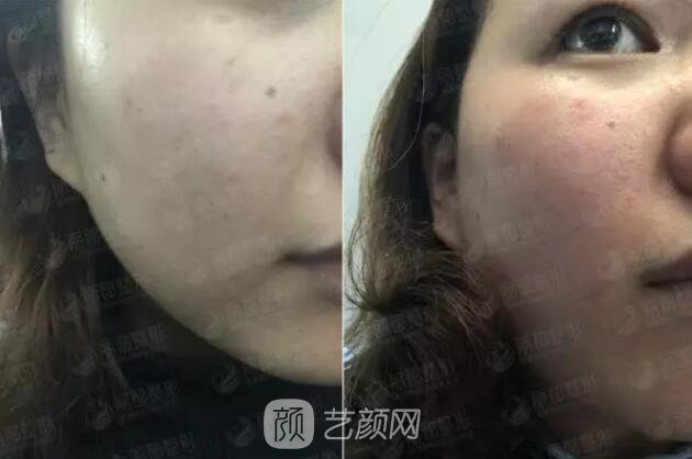 祛紅血絲的N種方式，讓你告別尷尬“紅臉蛋兒”！