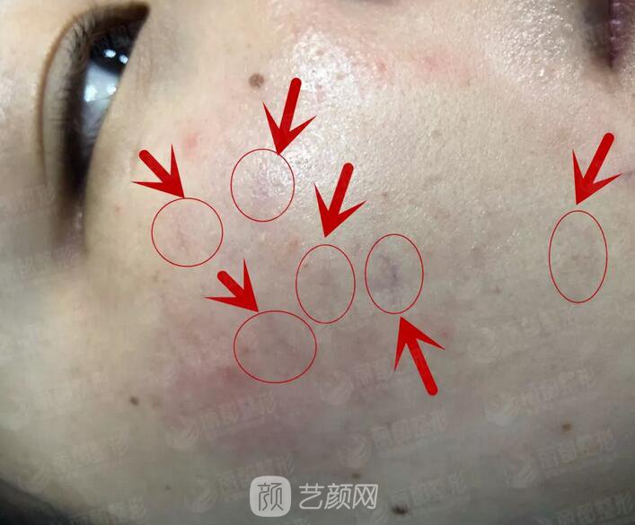 祛紅血絲的N種方式，讓你告別尷尬“紅臉蛋兒”！