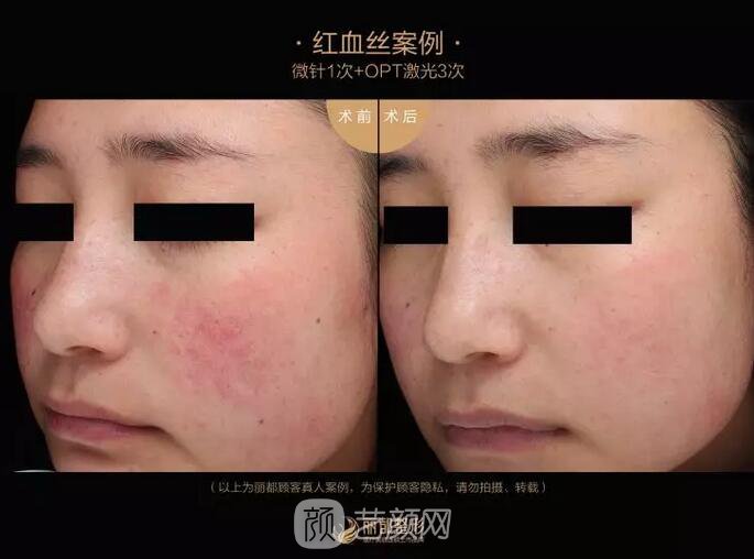 祛紅血絲的N種方式，讓你告別尷尬“紅臉蛋兒”！