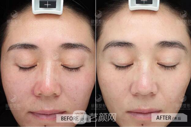 祛紅血絲的N種方式，讓你告別尷尬“紅臉蛋兒”！