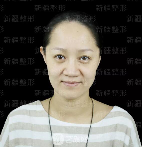 埋線提升提拉只是下垂的皮膚？不，更是我逝去的年華~