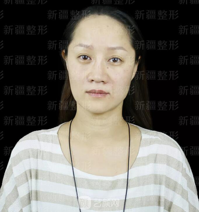 埋線提升提拉只是下垂的皮膚？不，更是我逝去的年華~