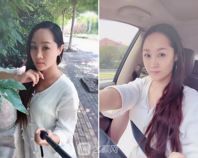 埋線提升提拉只是下垂的皮膚？不，更是我逝去的年華~