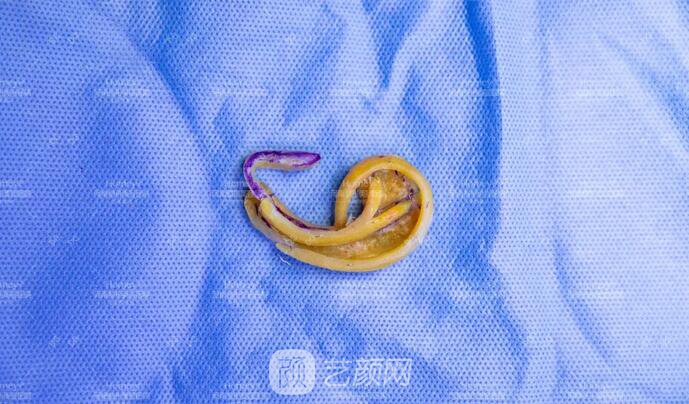 【取肋軟骨會影響孩子胸廓發(fā)育嗎？】