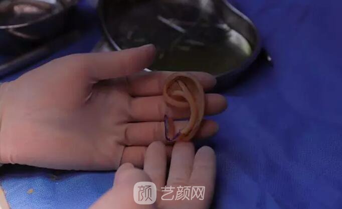 【再造的耳朵軟硬度摸起來和正常耳朵一樣嗎？】