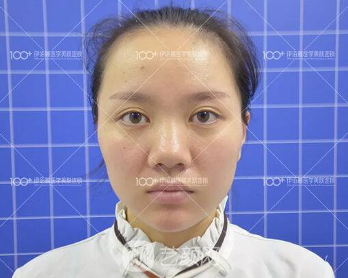 耳軟骨隆鼻術(shù)后一個月的果，真實日記一則給大家看看~