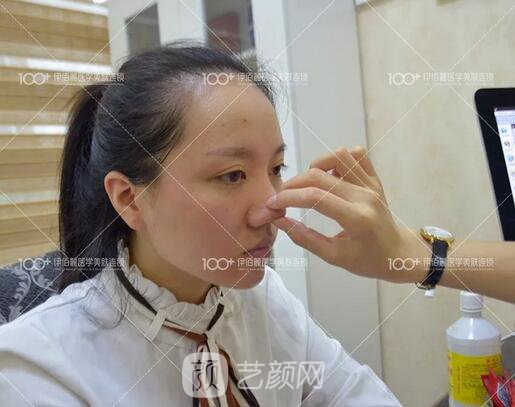 耳軟骨隆鼻術(shù)后一個月的果，真實日記一則給大家看看~