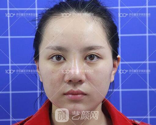 耳軟骨隆鼻術(shù)后一個月的果，真實日記一則給大家看看~