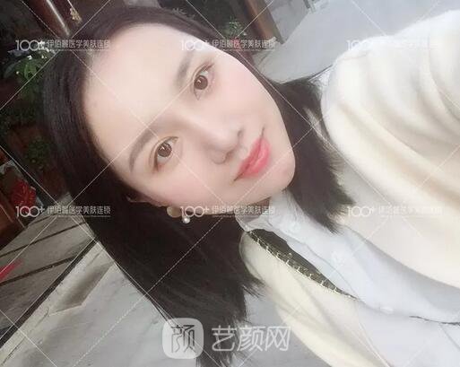 耳軟骨隆鼻術(shù)后一個月的果，真實日記一則給大家看看~