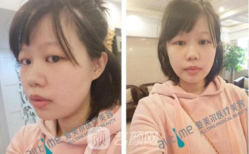 福州愛美爾王*全切雙眼皮真實案例