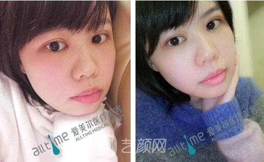 福州愛美爾王*全切雙眼皮真實案例