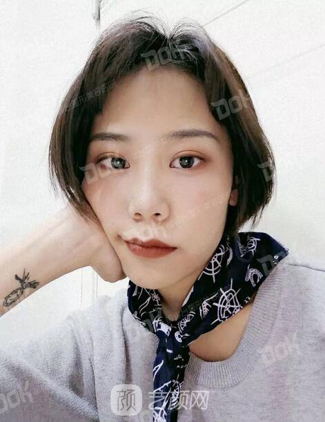 內(nèi)切祛眼袋果怎么樣？來(lái)瞧瞧這些照片就可能會(huì)有答案了哦~