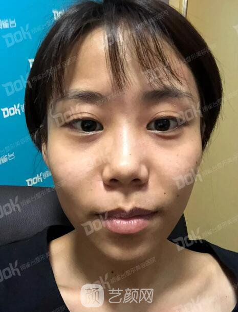 內(nèi)切祛眼袋果怎么樣？來(lái)瞧瞧這些照片就可能會(huì)有答案了哦~