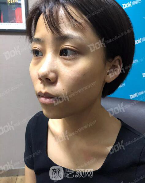 內(nèi)切祛眼袋果怎么樣？來(lái)瞧瞧這些照片就可能會(huì)有答案了哦~