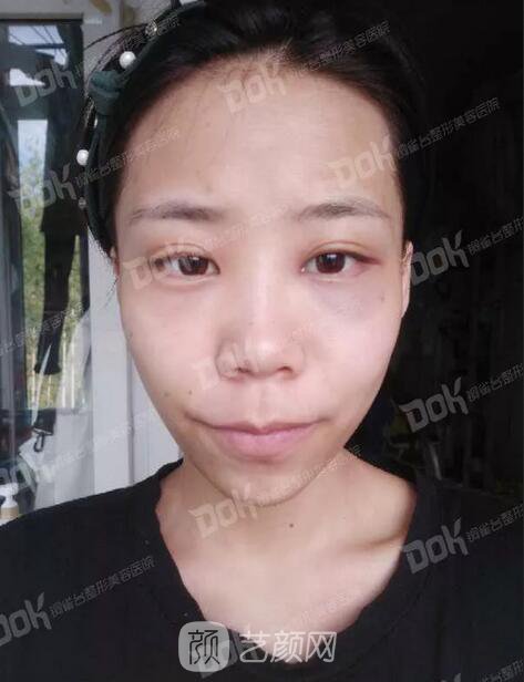 內(nèi)切祛眼袋果怎么樣？來(lái)瞧瞧這些照片就可能會(huì)有答案了哦~