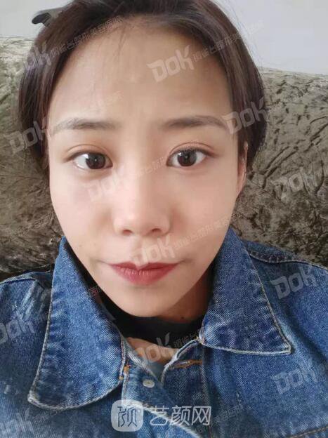 內(nèi)切祛眼袋果怎么樣？來(lái)瞧瞧這些照片就可能會(huì)有答案了哦~