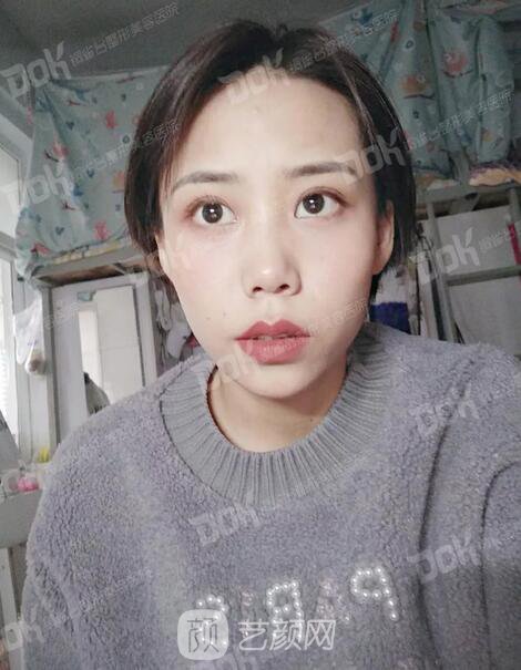 內(nèi)切祛眼袋果怎么樣？來(lái)瞧瞧這些照片就可能會(huì)有答案了哦~