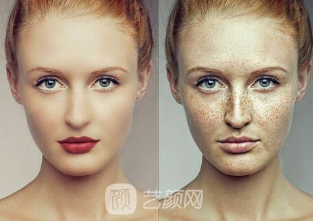 祛除雀斑后會反彈嗎?