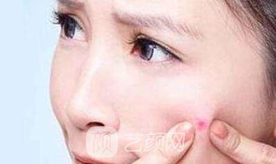 像素激光去痘是什么東西~沒問題嗎