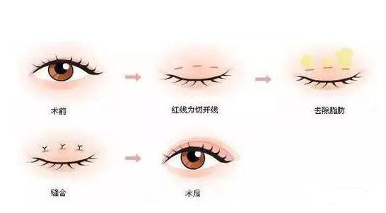 腫眼泡如何做雙眼皮