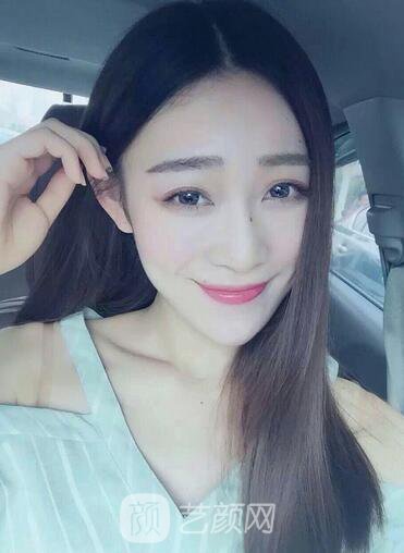 我去做了眉缺損修復術(shù)，怎么樣?很自然吧