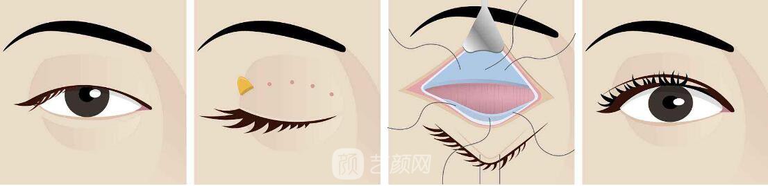 做了眼瞼下垂矯正后，眼睛又恢復(fù)正常狀態(tài)了