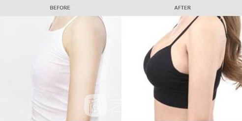 自體脂肪隆胸了，老公天天不加班了~