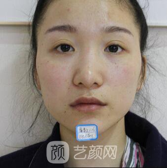 韓式翹鼻-真人案例，直呼我是混血兒