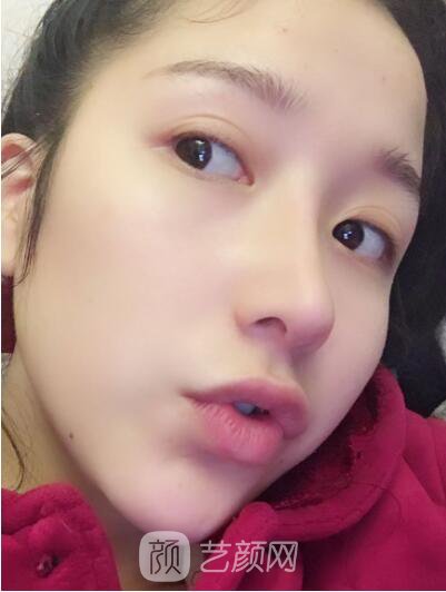 韓式翹鼻-真人案例，直呼我是混血兒