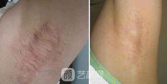 我去做了燒傷疤痕整形手術(shù)，現(xiàn)在已恢復(fù)如此了