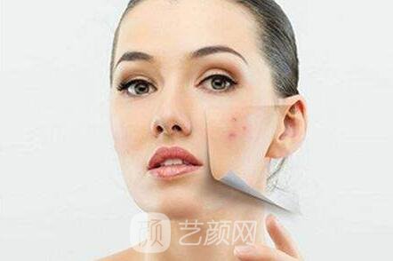 長沙雅美紅藍光祛痘果超棒