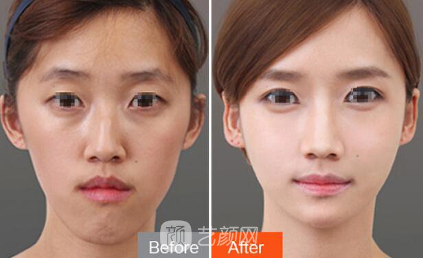 自體脂肪填充面部高清